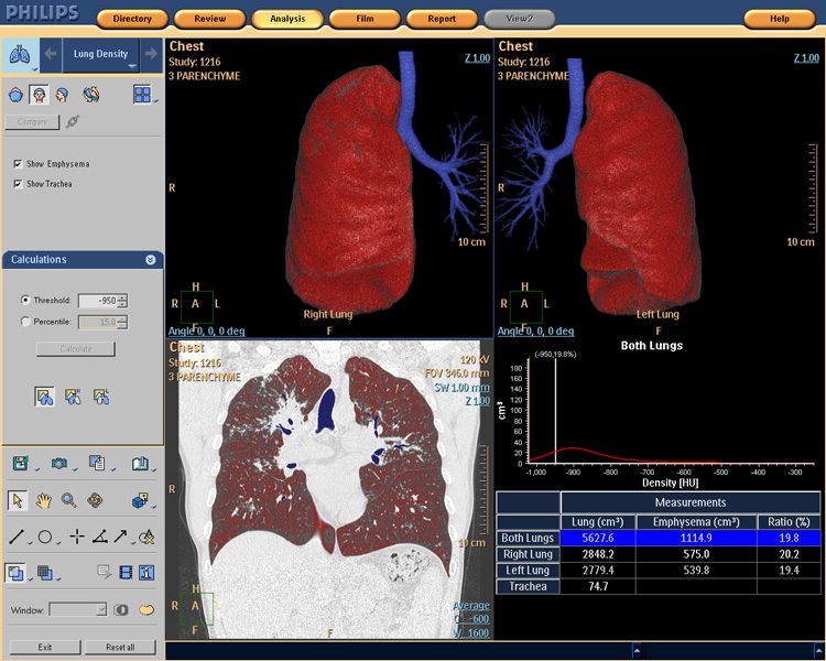 Lung Density 1