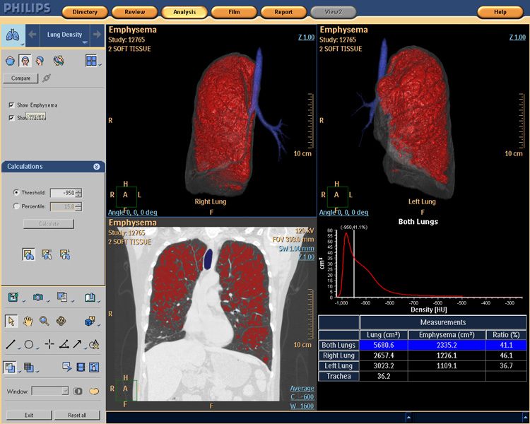 Lung Density 2